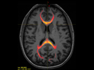 An MRI image from a patient with mild traumatic brain that highlights the nerve fibers of the corpus callosum, an area that helps the two halves of the brain "talk" to each other. These fibers may be damaged after a concussion.