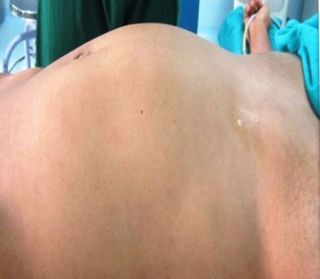A large lump in a teenager's stomach turned out to be her own 